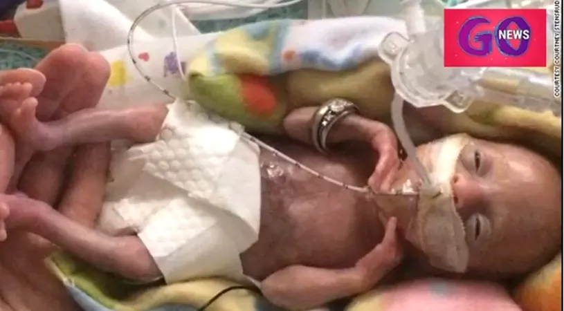 Fetita nascuta prematur la 21 de saptamani a implinit 3 ani! Povestea bebelusului care a venit pe lume la 425 de grame
