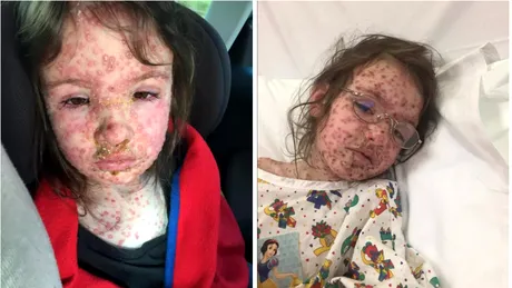 Fetita asta de 5 ani sufera de cea mai grava forma de varicela pe care au vazut-o doctorii vreodata! Cum a ajuns sa arate in halul asta si ce s-a intamplat cu ea?