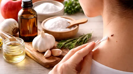 Remediu natural pentru alunițe? Ce este mit și ce spun specialiștii despre îngrijirea pielii