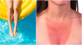 Alergia la soare. Cauze, simptome si tratament