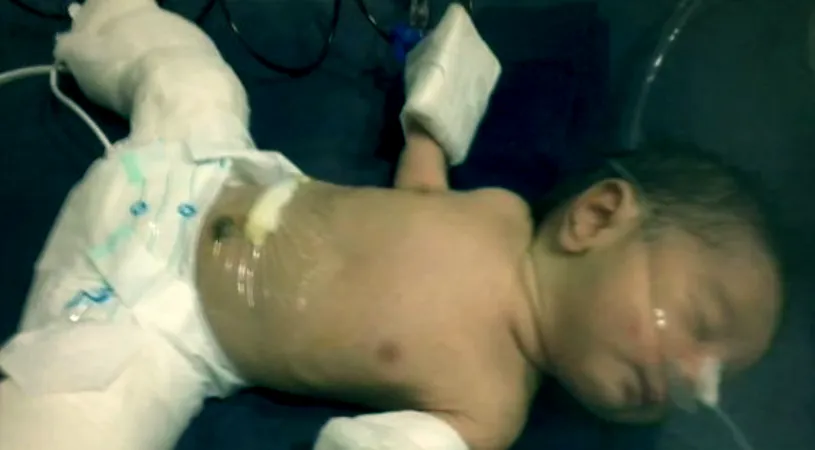 Un bebelus s-a nascut insarcinat! Cazul care a socat o lume intreaga. Cum explica medicii asa ceva
