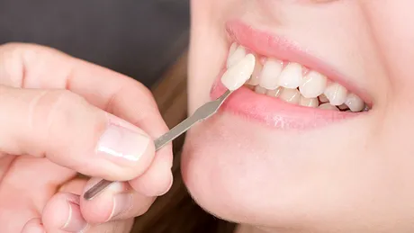 De ce recomandă medicii stomatologi fațetele dentare