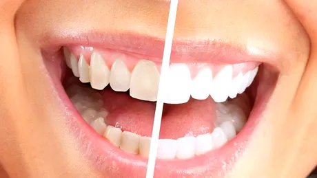 Scapa de tartru de pe dinti la tine acasa! Ce ingrediente ieftine si naturale te ajuta sa ai dantura curata VIDEO