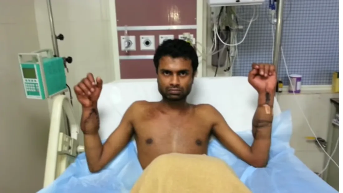Imagini uluitoare cu un barbat care a suferit un transplant de maini si si-a revenit spectaculos in doar 1 an de la interventie! VIDEO