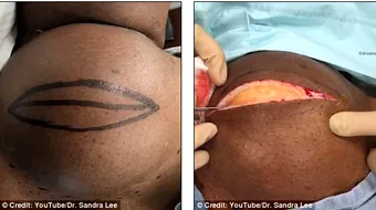 Ingrozitor! Ce i-au scos medicii unui tanar dintr-un punct de grasime imens. Era cat pe ce sa-l omoare