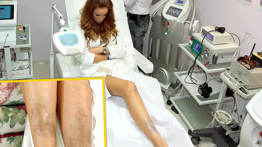 Bianca Dragusanu, probleme cu picioarele. Medicii i-au dat un verdict TRIST!