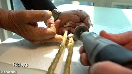 Groaznic! Batranul asta nu si-a taiat unghiile de 60 de ani si au ajuns sa masoare 2 metri. Cum arata degetele lui VIDEO