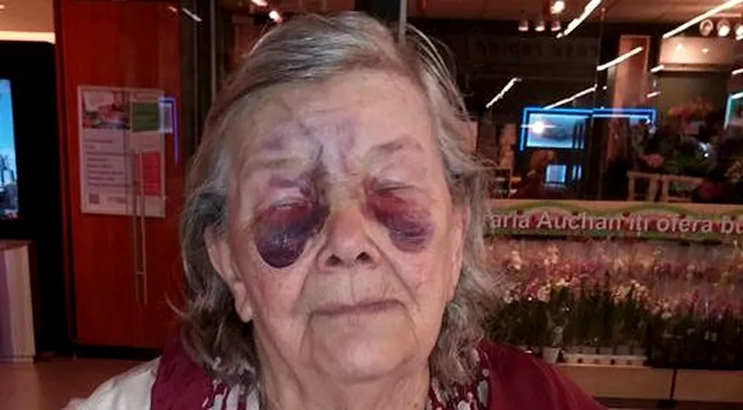 Cruzime fara margini! Aceasta batranica a fost batuta cu bestialitate de propria fiica! Biata femeie are fata desfigurata :(