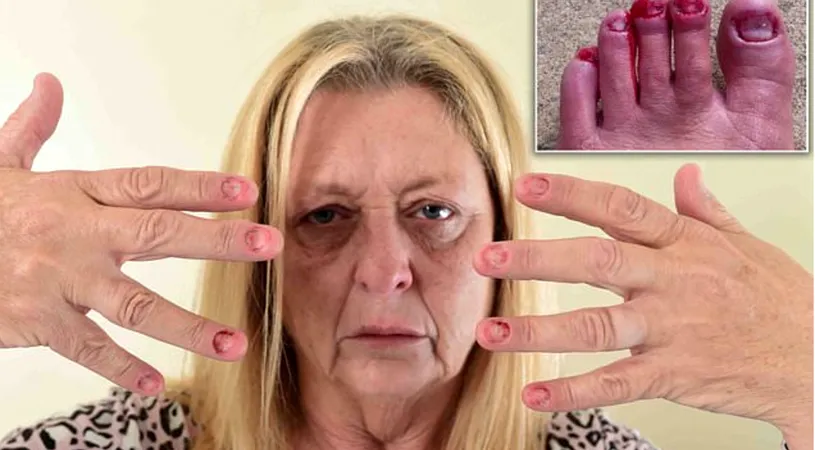Femeia de 53 de ani careia ii cad toate unghiile fara sa faca nimic! Imaginile groaznice cu degetele ei si cum boala asta misterioasa i-a distrus viata!