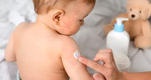 Remediu pentru pielea atopică la copii. Ce poate ajuta la calmarea uscăciunii și a disconfortului