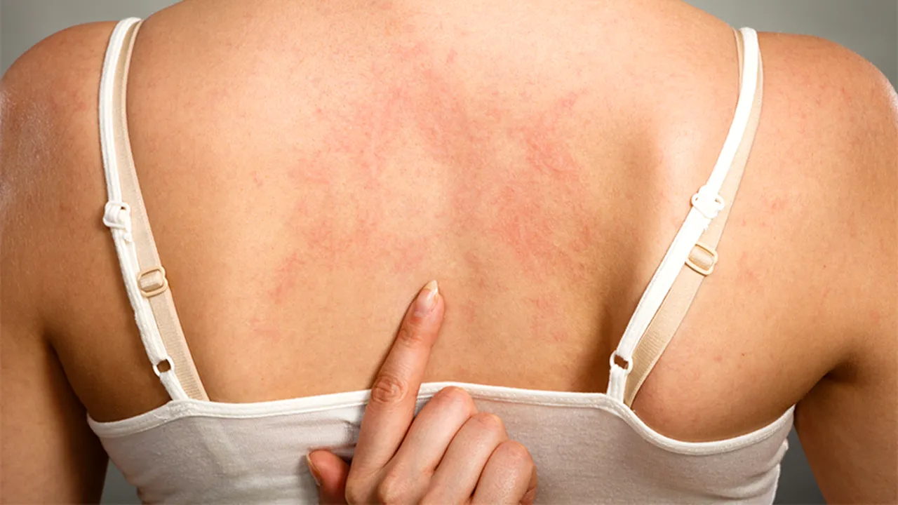 cand_apare_urticaria 