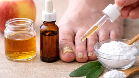 Remediu pentru ciuperca unghiilor – ce funcționează cu adevărat și cum previi reapariția