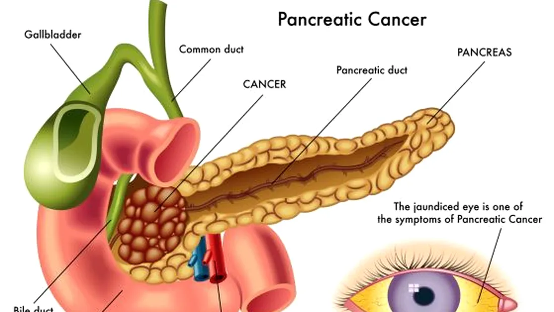 Aplicatia care iti spune daca ai cancer la pancreas. Cum functioneaza