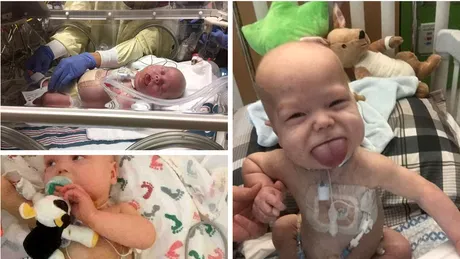 Bebelusul care s-a nascut cu limba uriasa avea o forma rara de cancer si a trebuit operat imediat dupa nastere! Cum arata in prezent copilul?!
