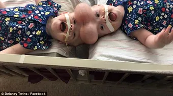 S-au nascut lipite in zona capului, insa medicii au reusit sa le separe! Cum arata gemenele acum