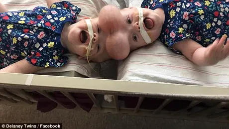 S-au nascut lipite in zona capului, insa medicii au reusit sa le separe! Cum arata gemenele acum