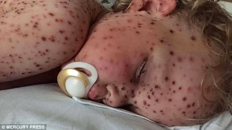 Copilul asta a fost la un pas de moarte dupa ce i-au aparut bubele astea pe tot corpul! Cum a fost salvat micutul si de ce boala suferea VIDEO