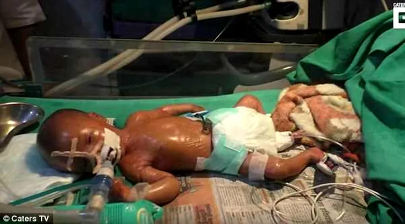 Nou-nascutul cu pielea de plastic! Cum arata baietelul cu pielea lucioasa si perfect intinsa. E incredibil!