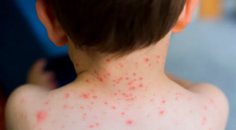 Ce este varicela. Cauze, simptome și tratament