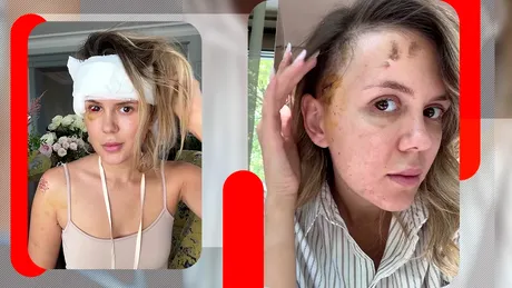 Emily Burghelea, detalii despre starea de sănătate, după accidentul din Mauritius. Blondina a trecut printr-o operaţie complicată