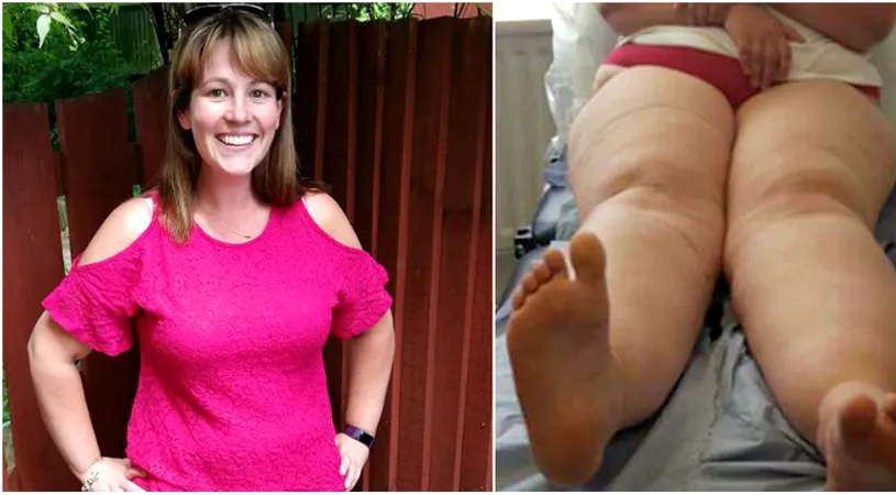 Femeia sufera de o maladie rara si arata cumplit! Cand a ajuns pe masa de operatie medicii i-au scos 22 de litri de grasime din picioare! CE se intampla cu ea