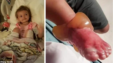 O femeie a bagat o fetita de 2 ani cu picioarele in apa fiarta pentru ca nu era cuminte. Acum copila risca sa-i fie amputate ambele picioare