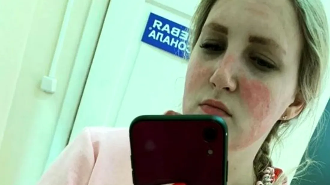 O asistentă medicală s-a ales cu arsuri de gradul II, din cauza măștii! ”Mi-a distrus fața”