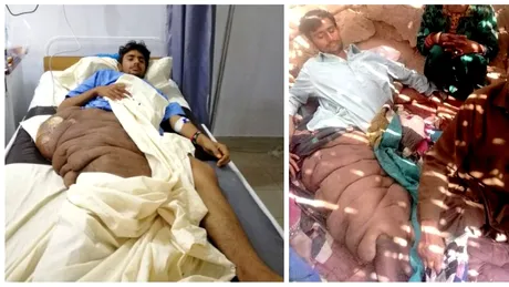 Tumora de 20 de kg care i-a distrus viata unui student. Tanarul e disperat sa scape de ea. De ce nu il opereaza medicii