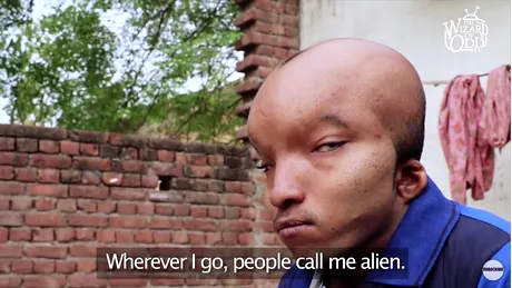 VIDEO! Baiatul extraterestru traieste in India! Capul lui este incredibil de mare si ochii sunt dispusi aproape lateral!