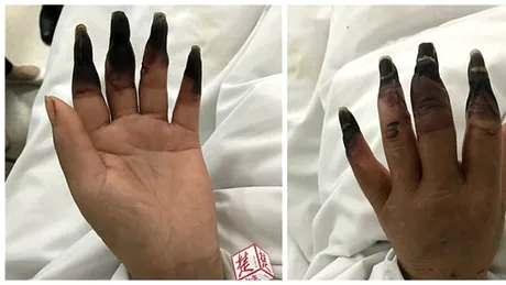 Unei femei i-au putrezit degetele de la maini. Ce NU a facut pacienta de a ajuns in halul acesta