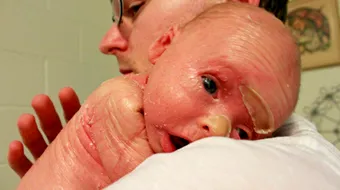 Pielea acestui copil cade in fiecare zi! Boala crunta de care sufera