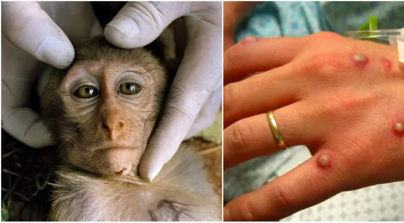 Ce este variola maimutelor si cat de periculoasa e pentru oameni. Primul caz a fost confirmat in Europa