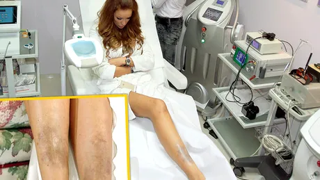 Bianca Dragusanu, probleme cu picioarele. Medicii i-au dat un verdict TRIST!