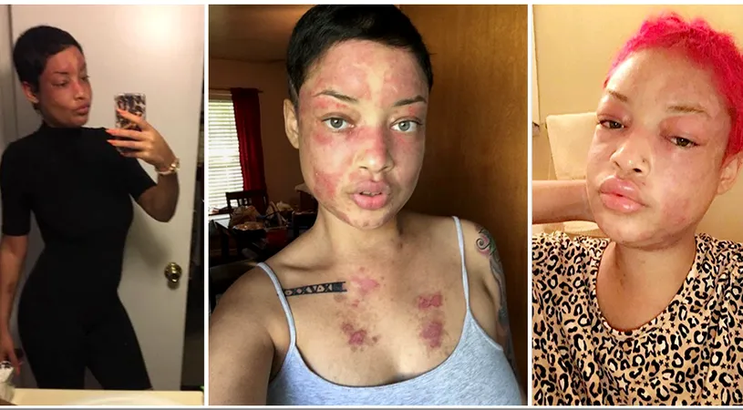 Boala de care aceasta tanara sufera! Pielea ei este plina de basici si pare arsa mereu VIDEO