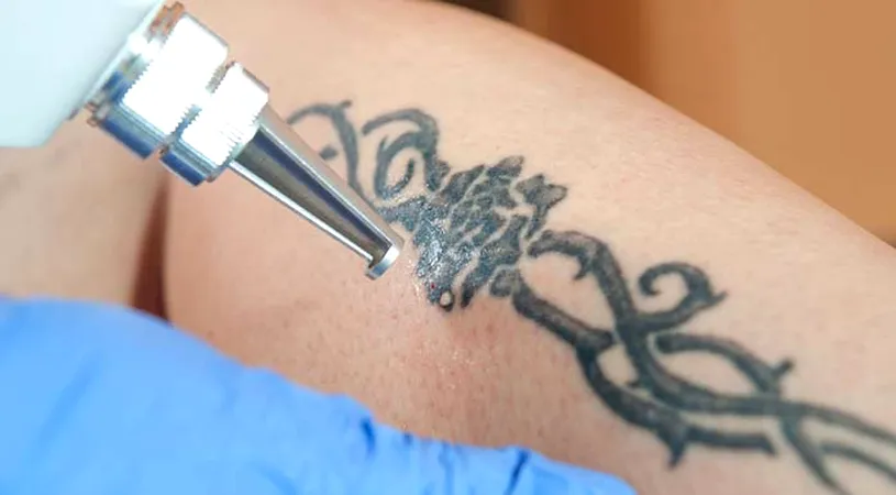 Cum scap de un tatuaj? Dr. Levy îți arată LIVE