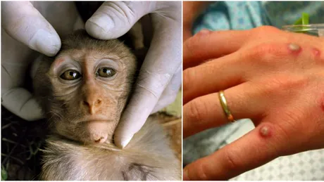 Ce este variola maimutelor si cat de periculoasa e pentru oameni. Primul caz a fost confirmat in Europa