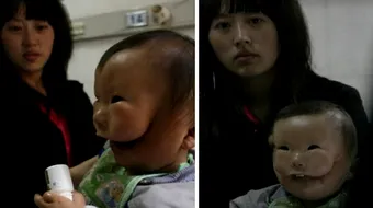 Povestea terifiantă a băiatului cu mască. Afecțiunea care i-a îngrozit până și pe medici!