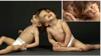 Fetitele astea impart acelasi creier! Nimeni n-a crezut ca ele vor putea trai asa! Cum arata acum – Atentie, imagini socante VIDEO