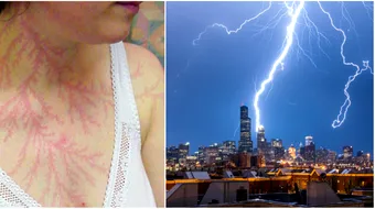 Asa arata pielea celor loviti de fulger! Supravietuitorii si-au aratat urmele infioratoare. Ce li s-a intamplat in scurt timp de la impact