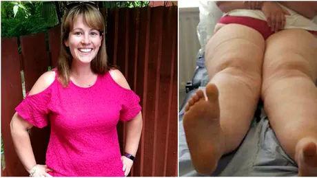 Femeia sufera de o maladie rara si arata cumplit! Cand a ajuns pe masa de operatie medicii i-au scos 22 de litri de grasime din picioare! CE se intampla cu ea