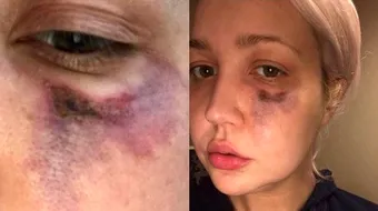 Oribil! O concurenta de la ‘Vocea’ a ramas cu o gaura imensa in fata. Ce insecta periculoasa a muscat-o VIDEO