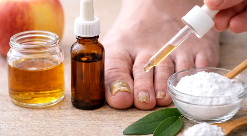 Remediu pentru ciuperca unghiilor – ce funcționează cu adevărat și cum previi reapariția