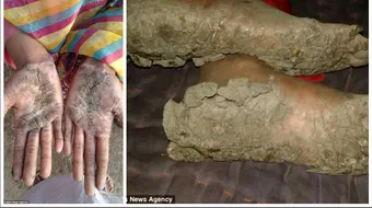 Copiii care se transforma in piatra! Cei 5 micuti ai familiei devin statui si nimeni nu-i poate salva! Ce se intampla cu pielea lor