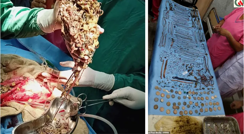 VIDEO! Femeia care a furat 1,5 kilograme de bijuterii si le-a inghitit era la un pas sa moara! Medicii au fost socati cand au operat-o!