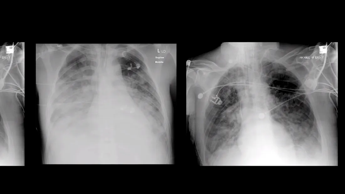 Cum sunt plămânii afectați din cauza coronavirusului! Videoclipul care arată cum se pot deteriora organele din corp