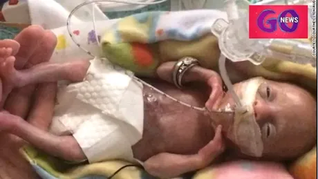 Fetita nascuta prematur la 21 de saptamani a implinit 3 ani! Povestea bebelusului care a venit pe lume la 425 de grame