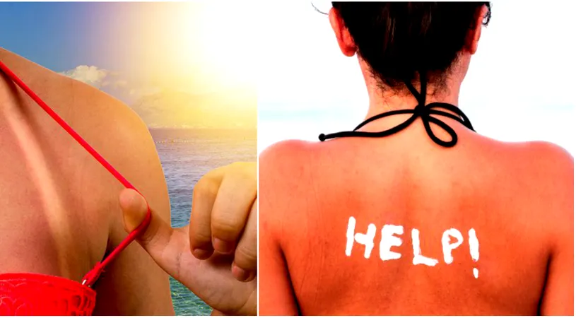 Produsul care vindeca arsurile solare. A fost descoperit de o femeie, din greseala! Trebuie sa ti-l iei si tu vara asta