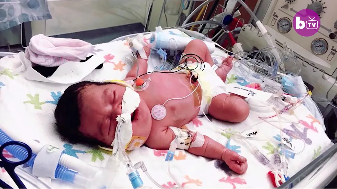 Cum arata astazi fetita care s-a nascut cu o tumora imensa la gat! Are doar 2 ani si medicii nu-i pot face nimic! VIDEO