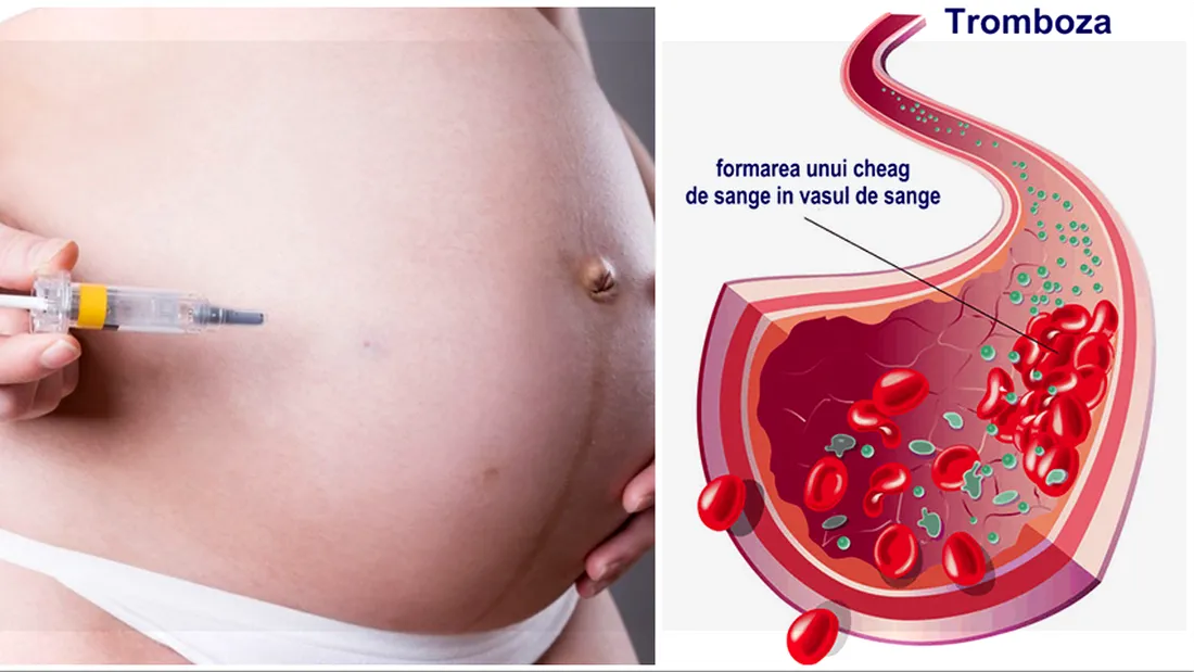 Trombofilia in sarcina. Simptomele bolii care poate opri sarcina din evolutie