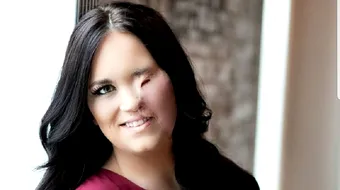 S-a desfigurat cu ondulatorul de par! Femeia a suferit arsuri grave. Imagini care va pot afecta emotional